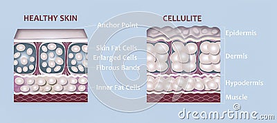 forming of underskin cellulite illustration Cartoon Illustration