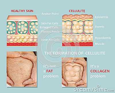 forming of underskin cellulite illustration Cartoon Illustration