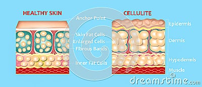 forming of underskin cellulite illustration Cartoon Illustration