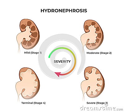 Four stages of kidney hydronephrosis. Vector illustration of the mild moderate severe and terminal kidney disease Vector Illustration