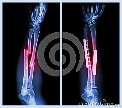 Fracture both bone of forearm. It was operated and internal fixed with plate and Stock Photo