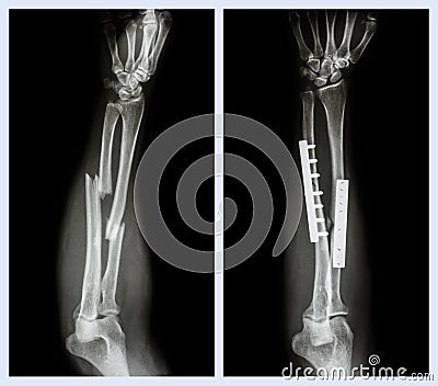 Fracture both bone of forearm. It was operated and internal fixed with plate and Stock Photo