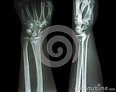 Fracture distal radius (Colles' fracture) Stock Photo