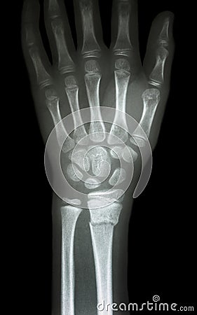 Fracture distal radius (forearm's bone) Stock Photo