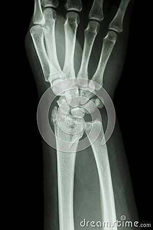 Fracture distal radius (forearm's bone) Stock Photo