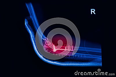 Fracture Elbow, forearm x-rays image Stock Photo