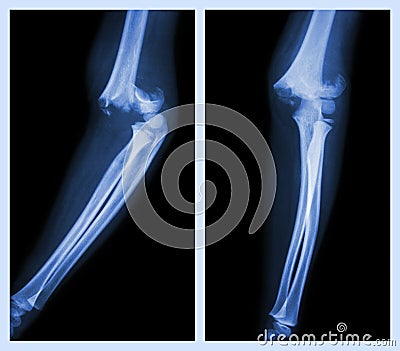 Fracture elbow (Left image : side position , Right image : front position) Stock Photo