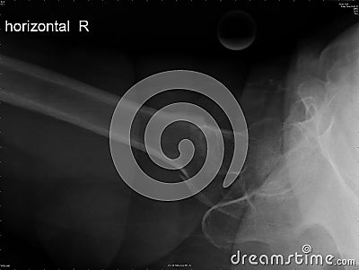 Fracture of femoral bone Stock Photo