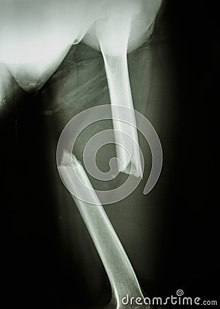 Fracture femur Stock Photo