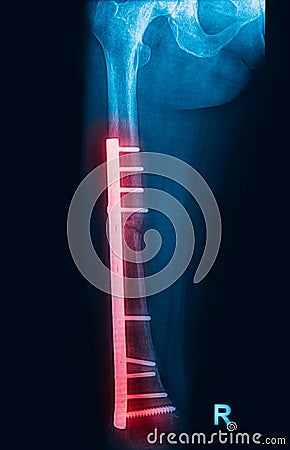 Fracture femur, femur x-rays image Stock Photo