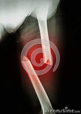 Fracture femur Stock Photo