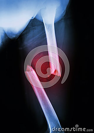 Fracture femur Stock Photo