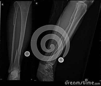 Fracture of fibular and tibial bone Stock Photo