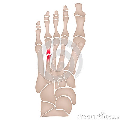 Fracture of the metatarsal bones in the foot. Anatomical structure of the foot. Skeleton. Broken bones. Vector Vector Illustration