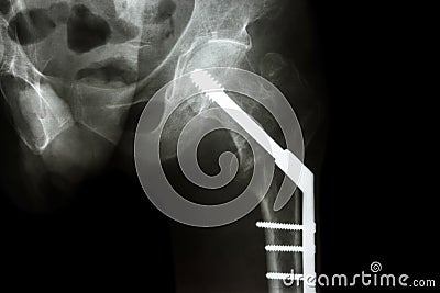 Fracture neck of femur(thigh's bone). patient was operated and f Stock Photo