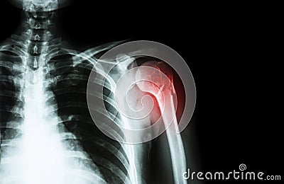 Fracture at neck of humerus ( arm bone ) ( film x-ray left shoulder and blank area at right side ) Stock Photo