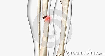 A fracture, often referred to as a broken bone, is an acute injury that causes a partial or complete break through bone Stock Photo