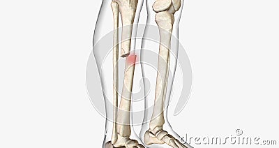 A fracture, often referred to as a broken bone, is an acute injury that causes a partial or complete break through bone Stock Photo