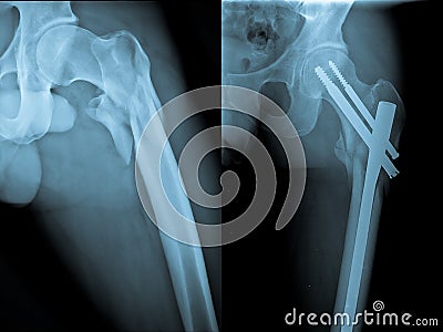 Fracture and repair of femoral bone Stock Photo