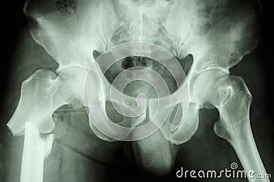 Fracture right femur (thigh's bone) Stock Photo