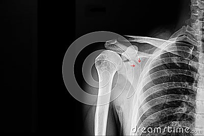 Fracture scapular Stock Photo