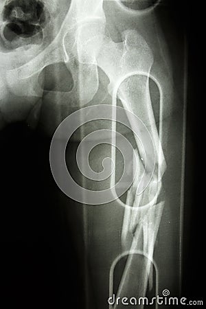 Fracture shaft of femur Stock Photo