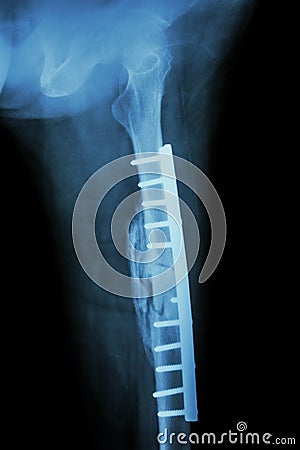 Fracture shaft of femur. It was operated and internal fixation Stock Photo