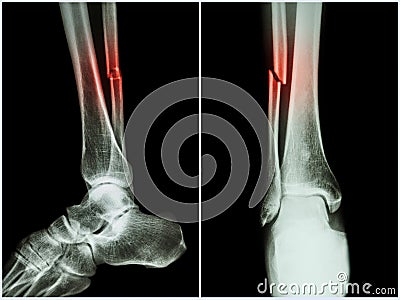 Fracture shaft of fibula bone ( leg bone ) . X-ray of leg ( 2 position : side and front view ) Stock Photo