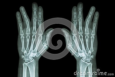 Fracture shaft of proximal phalange of ring finger ( film x-ray both hand AP ) Stock Photo