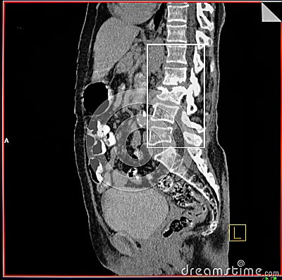 Fracture spine. Osteoporosis. CT reconstruction Stock Photo