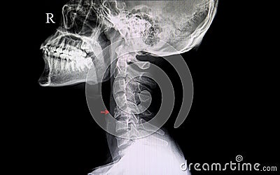 fractured cervical spine Stock Photo