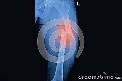 Fractured Femur, Broken thigh x-rays Stock Photo