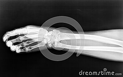 Fractures to the radius born of the right arm on an X-ray Stock Photo