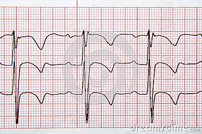 Fragment of a normal children`s electrocardiogram with arrhythmia elements. Stock Photo