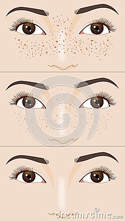 Freckle spots on the woman's face compare before and after skin treatment, illustration Cartoon Illustration