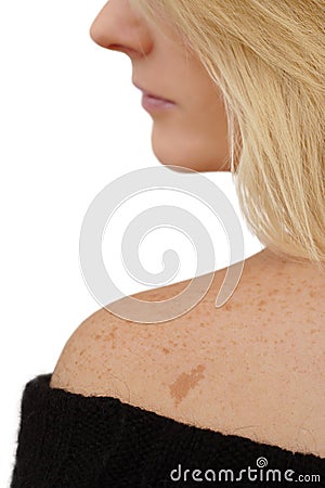 Freckles & Birth mark Stock Photo