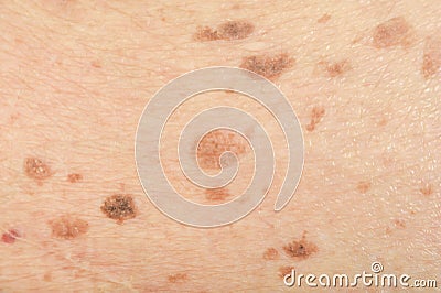 Freckles on the skin Stock Photo