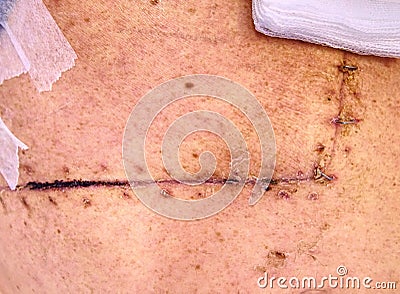 Fresh postoperative scar sewn with silver thread Stock Photo