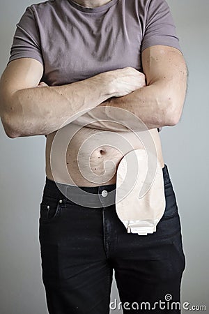 Front view on colostomy bag attached to man patient, medical theme. Skin color ostomy pouch close-up. Colon cancer surgery Stock Photo