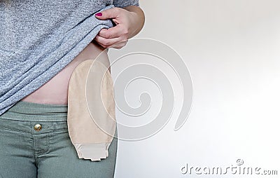 Front view on colostomy pouch in skin color attached to woman patient. Close-up on ostomy bag after surgery Stock Photo