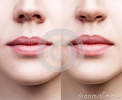 Front view on female nose before and after surgery. Stock Photo