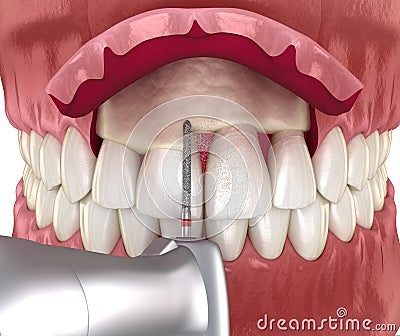 Frontal crown lengthening, Esthetic surgery. Medically accurate dental 3D illustration Cartoon Illustration