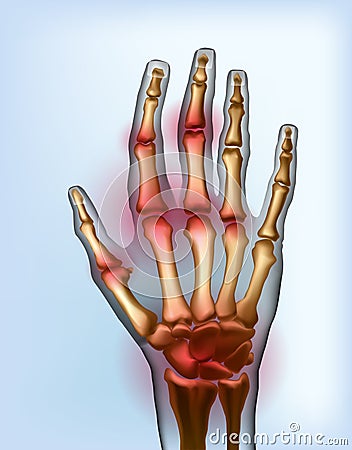 Frontal view image sore osteoarthritis joints of bones the of hand. Vector Illustration