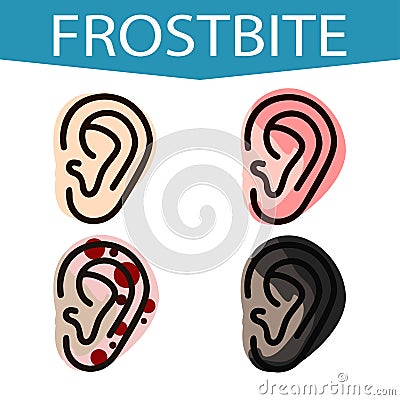 Frostbite. Stages of frostbite in the grass. The effects of hypothermia ear Roubini. Vector Illustration