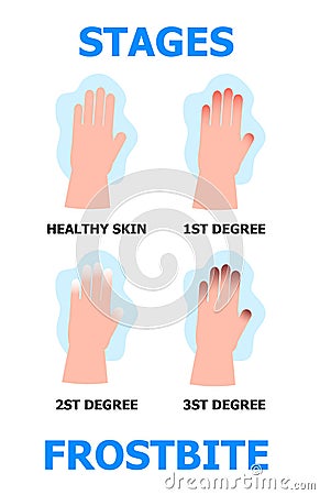 Frostbite stages info-graphic vector. Hypothermia in winter season. Problems with skin of frost fingers Stock Photo