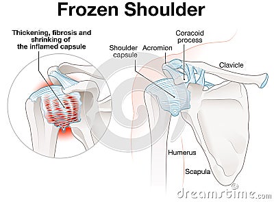 Frozen Shoulder Adhesive capsulitis Illustration. Labeled Cartoon Illustration