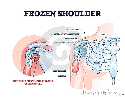 Frozen shoulder condition or adhesive capsulitis syndrome outline diagram Vector Illustration