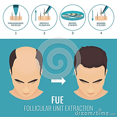 FUE hair loss treatment Vector Illustration