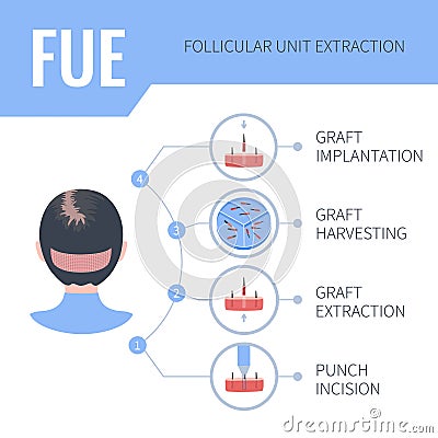 FUE hair transplantation medical infographics for women Vector Illustration