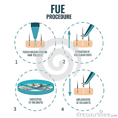 FUE stages treatment Vector Illustration